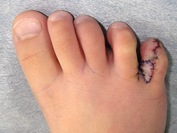 例：多合趾症3