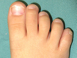 例：多合趾症4