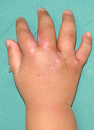 例：合指症、裂手症3