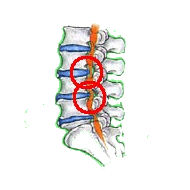 腰部脊柱管狭窄症2