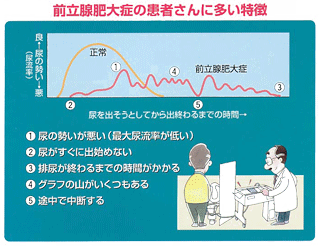 前立腺肥大症の患者さんに多い特徴