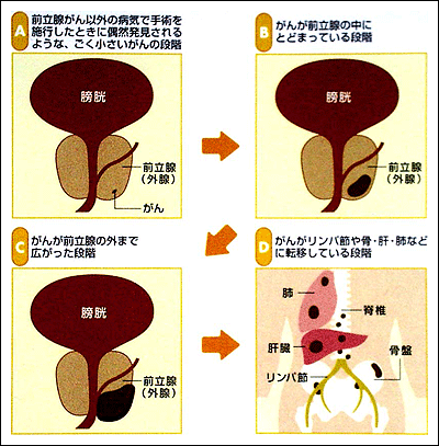 前立腺がんの病期分類