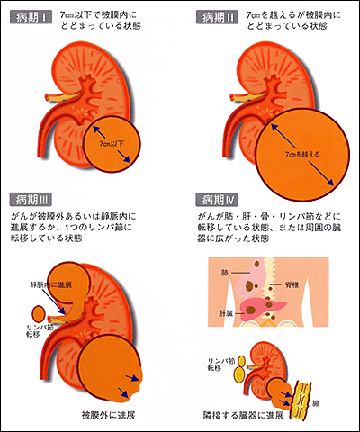 腎細胞がんの病期