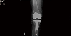 人工膝関節置換術1
