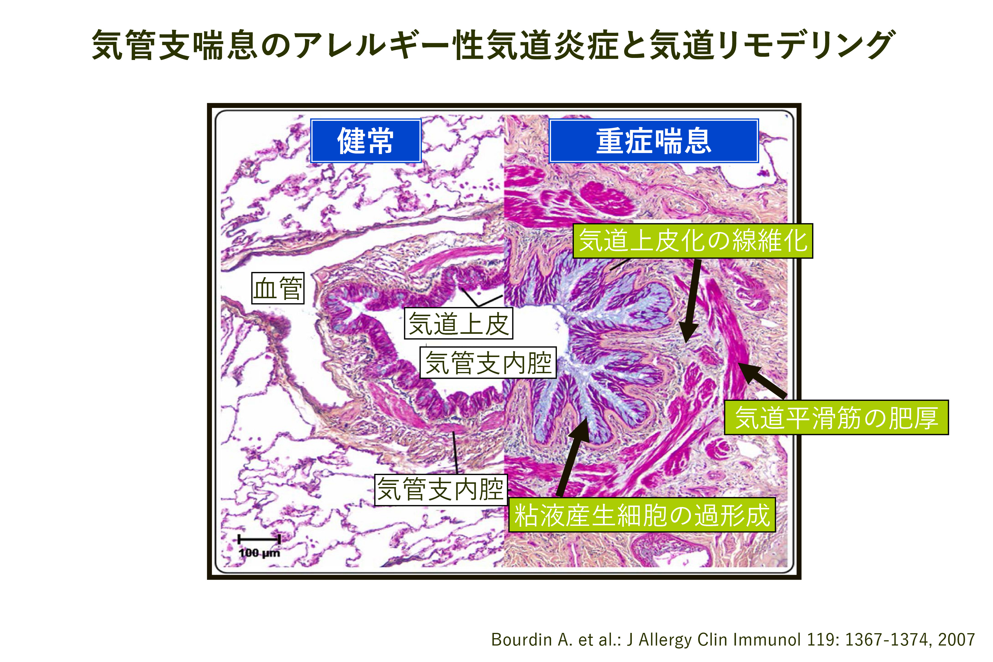 非古典的な副腎過形成